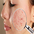 acne treatment